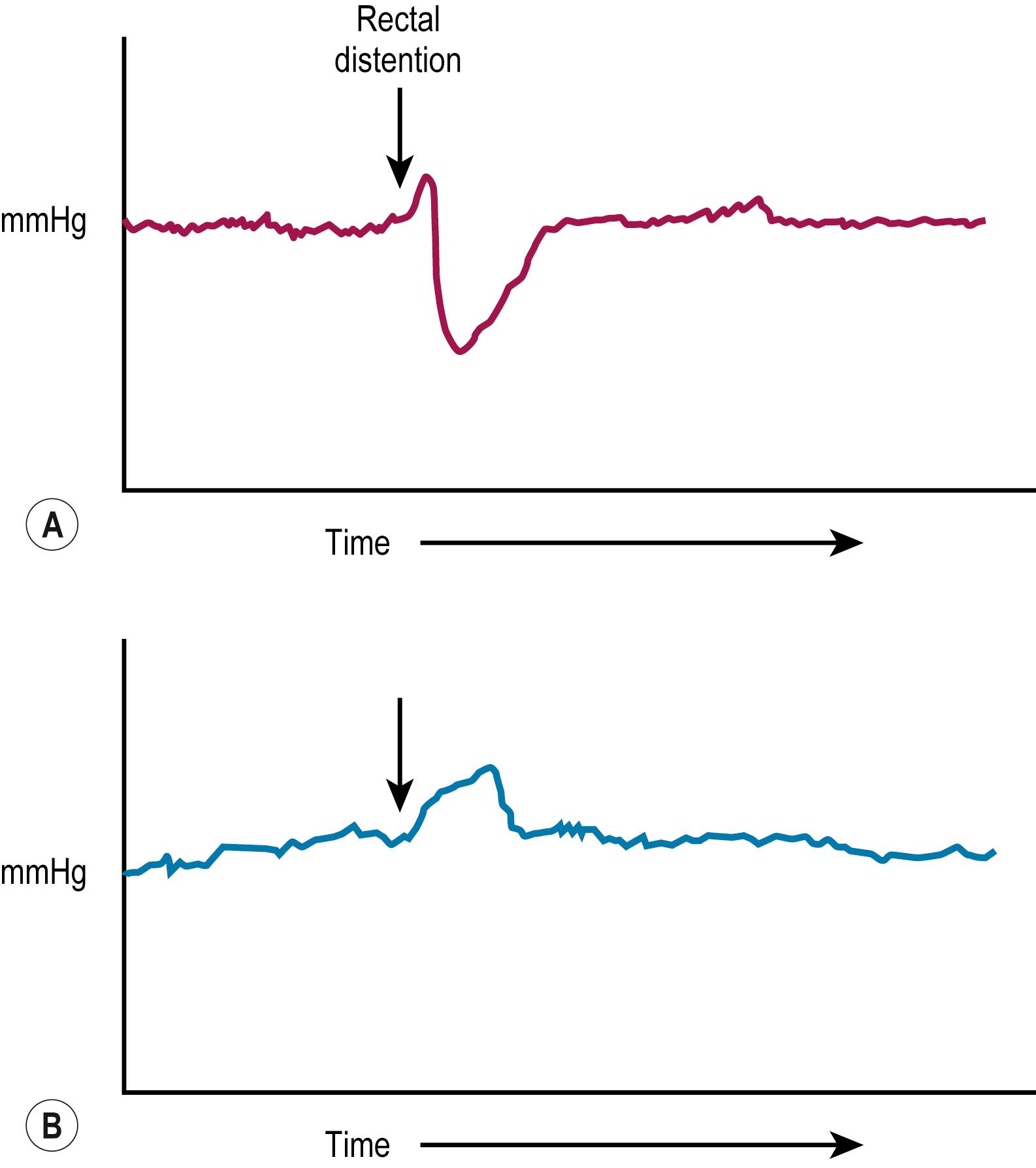 Fig. 34.3, (A) In the child without Hirschsprung disease undergoing anorectal manometry, the recto-anal inhibitory reflex is normal. Note the drop in the internal sphincter pressure with rectal distention. (B) A child with Hirschsprung disease is seen to have abnormally increased contraction of the anal canal and no relaxation of the internal sphincter with rectal distention. (The arrow points to the initiation of rectal distention in both A and B .)