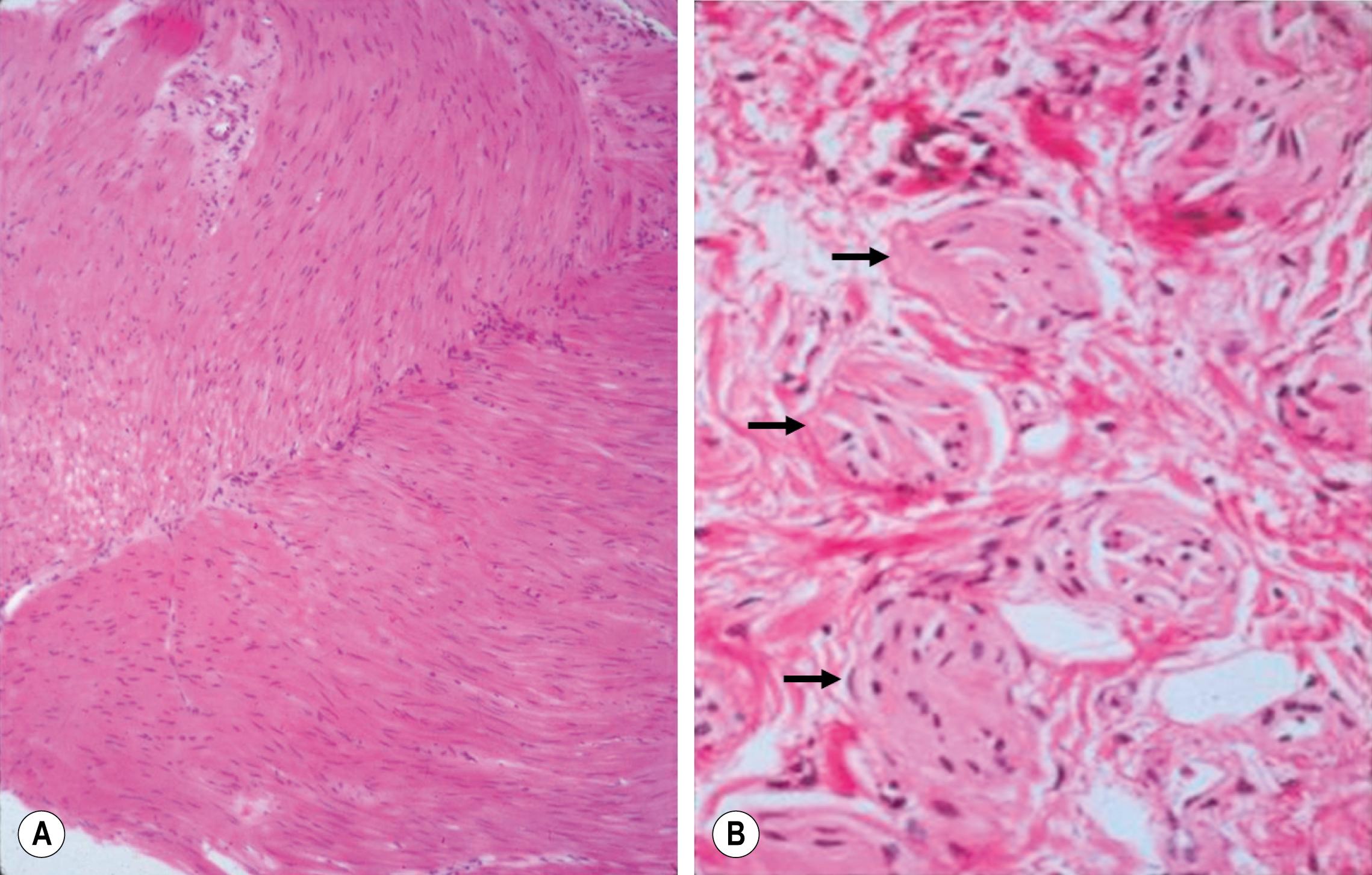 Fig. 34.4, Histologic findings in children with Hirschsprung disease. (A) Absence of ganglion cells in the myenteric plexus. (B) Hypertrophied nerve trunks are marked with arrows.