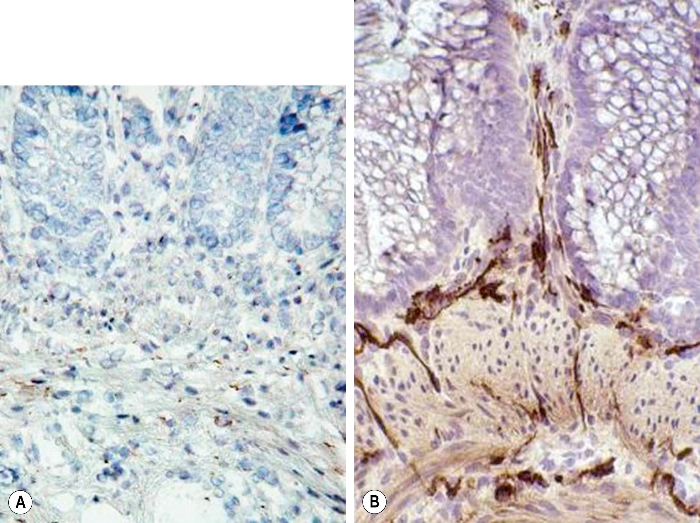 Fig. 34.5, Cholinesterase staining in (A) normal colon and (B) colon affected by Hirschsprung disease.