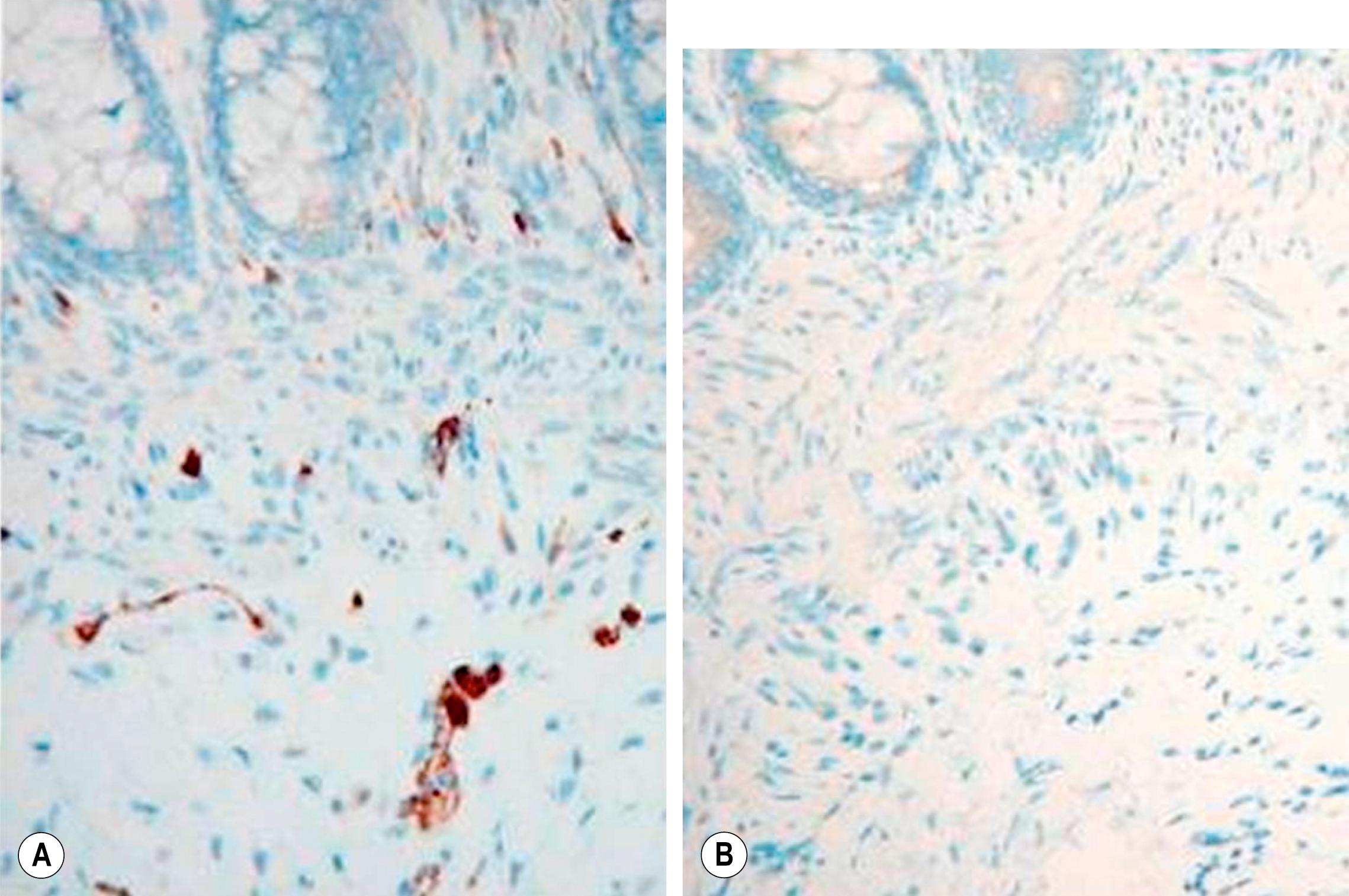 Fig. 34.6, Calretinin staining is seen in (A) normal colon but not in colon (B) affected by Hirschsprung disease.