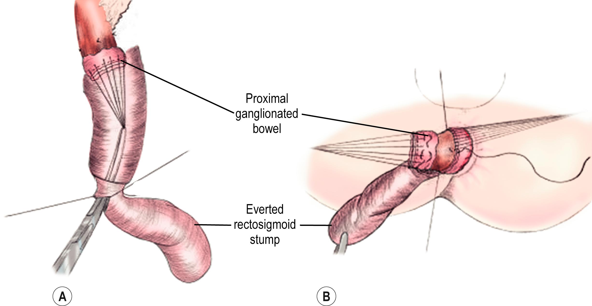 Fig. 34.8, The principles of the Swenson pull-through procedure are seen in these drawings. (A) The proximal ganglionated bowel is grasped through an incision in the prolapsed rectosigmoid stump. (B) The ganglionated bowel is then sewn to the anus.