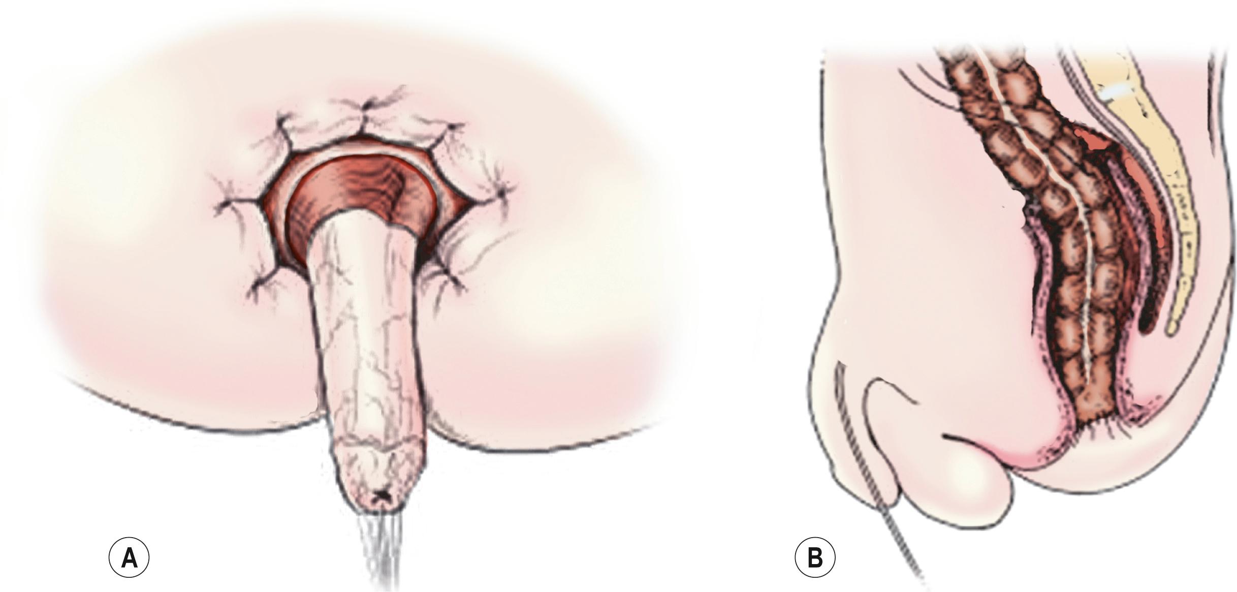 Fig. 34.9, (A) For the Soave operation, there is extramucosal dissection of the rectum after circumferential incision of the rectal mucosa. (B) The ganglionated colon is pulled through the aganglionic rectal cuff, and a coloanal anastomosis is performed.