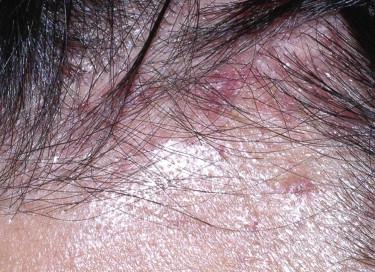 FIGURE 15-1, Cutaneous Langerhans cell disease manifesting as erythematous macules and papules.