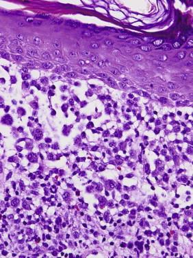 FIGURE 15-2, Cutaneous Langerhans cell disease. Dense infiltrate of mononuclear cells with reniform nuclei in dermis and epidermis.