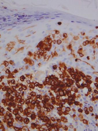 FIGURE 15-3, The mononuclear Langerhans cells in the dermis and epidermis are immunopositive for CD1a.