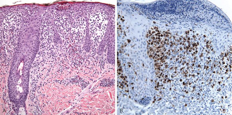 Figure 53-11, Langerhans cell histiocytosis, skin.