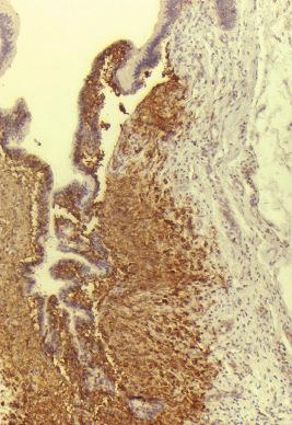 Figure 53-12, Langerhans cell histiocytosis of the bile duct.