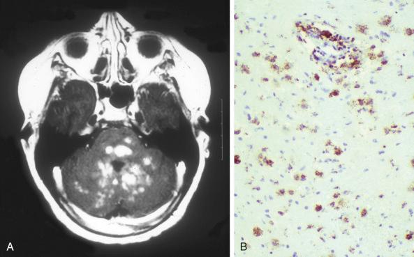 Figure 53-14, Langerhans cell histiocytosis, brain.