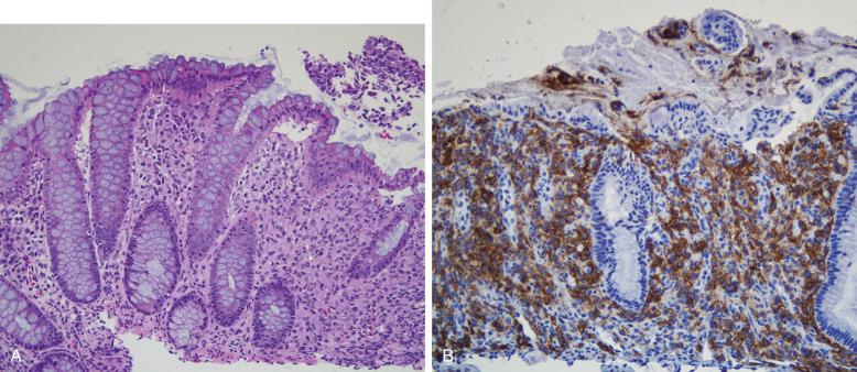 Figure 53-15, Langerhans cell histiocytosis, gastrointestinal tract.