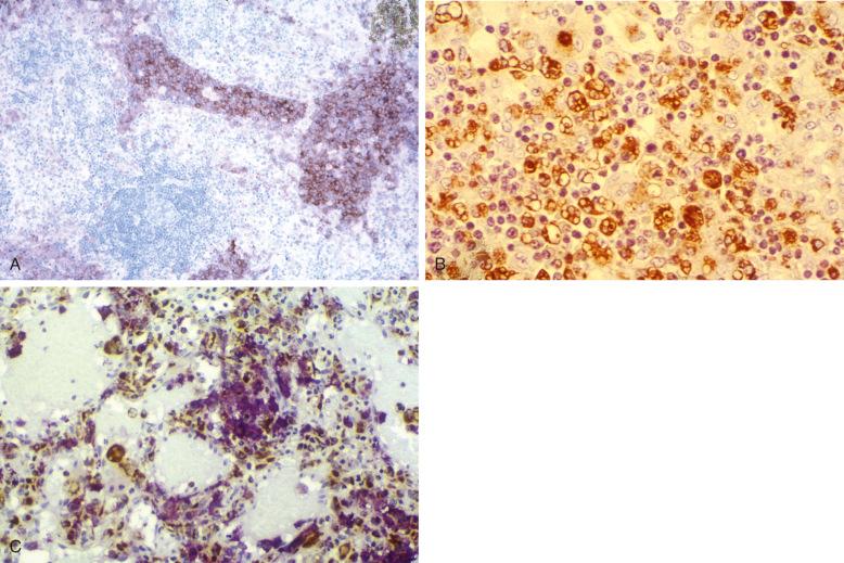 Figure 53-16, Langerhans cell histiocytosis and hemophagocytic syndrome.