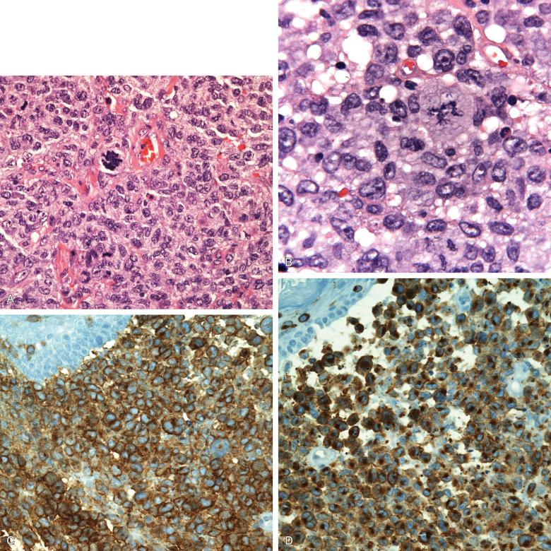 Figure 53-17, Langerhans cell sarcoma.