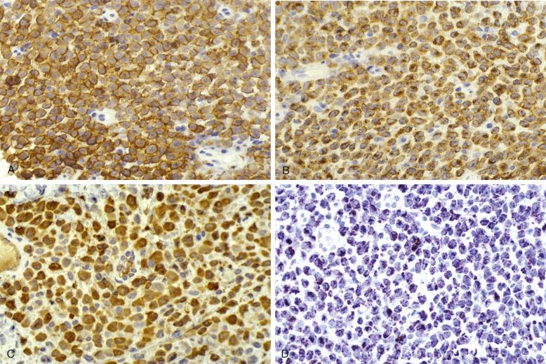 Figure 53-3, Langerhans cell histiocytosis, immunoprofile.