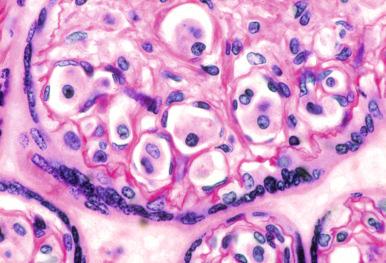 Figure 53-4, Placenta from a stillborn is filled with intravascular fetal cells that have features of Langerhans cell histiocytosis. The fetus had systemic foci of autolytic histiocytes (periodic acid–Schiff).