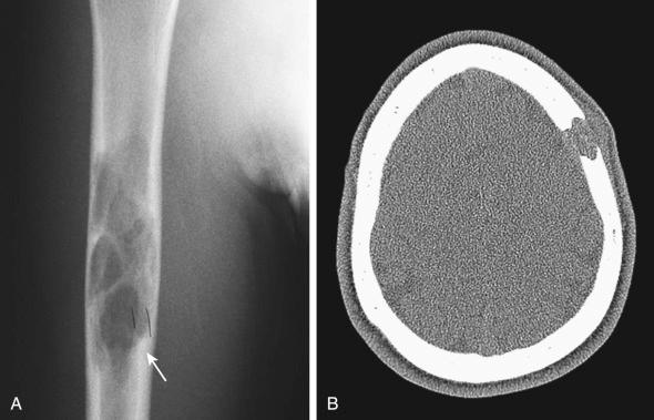 Figure 53-5, Langerhans cell histiocytosis in bone.