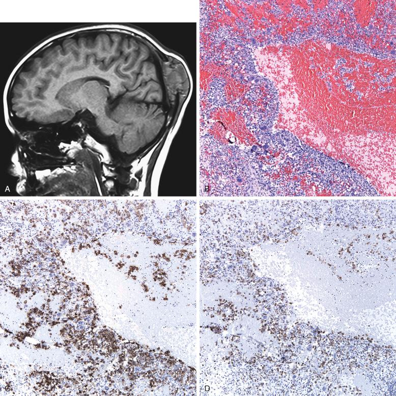 Figure 53-6, Bone Langerhans cell histiocytosis presenting as an aneurysmal bone cyst.