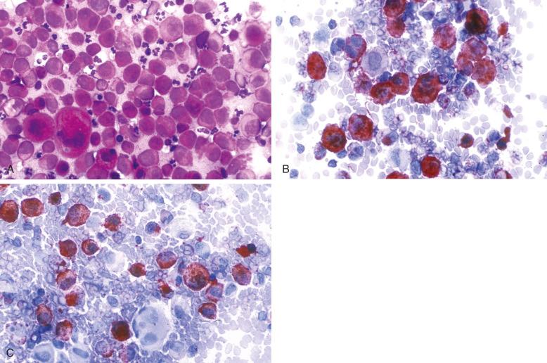 Figure 53-8, Langerhans cell histiocytosis, fine-needle aspirate.