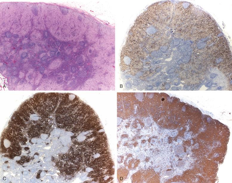 Figure 53-9, Dermatopathic lymphadenopathy simulating Langerhans cell histiocytosis, patient with eczema.