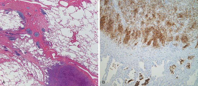 Figure 53-10, Langerhans cell histiocytosis, lung.