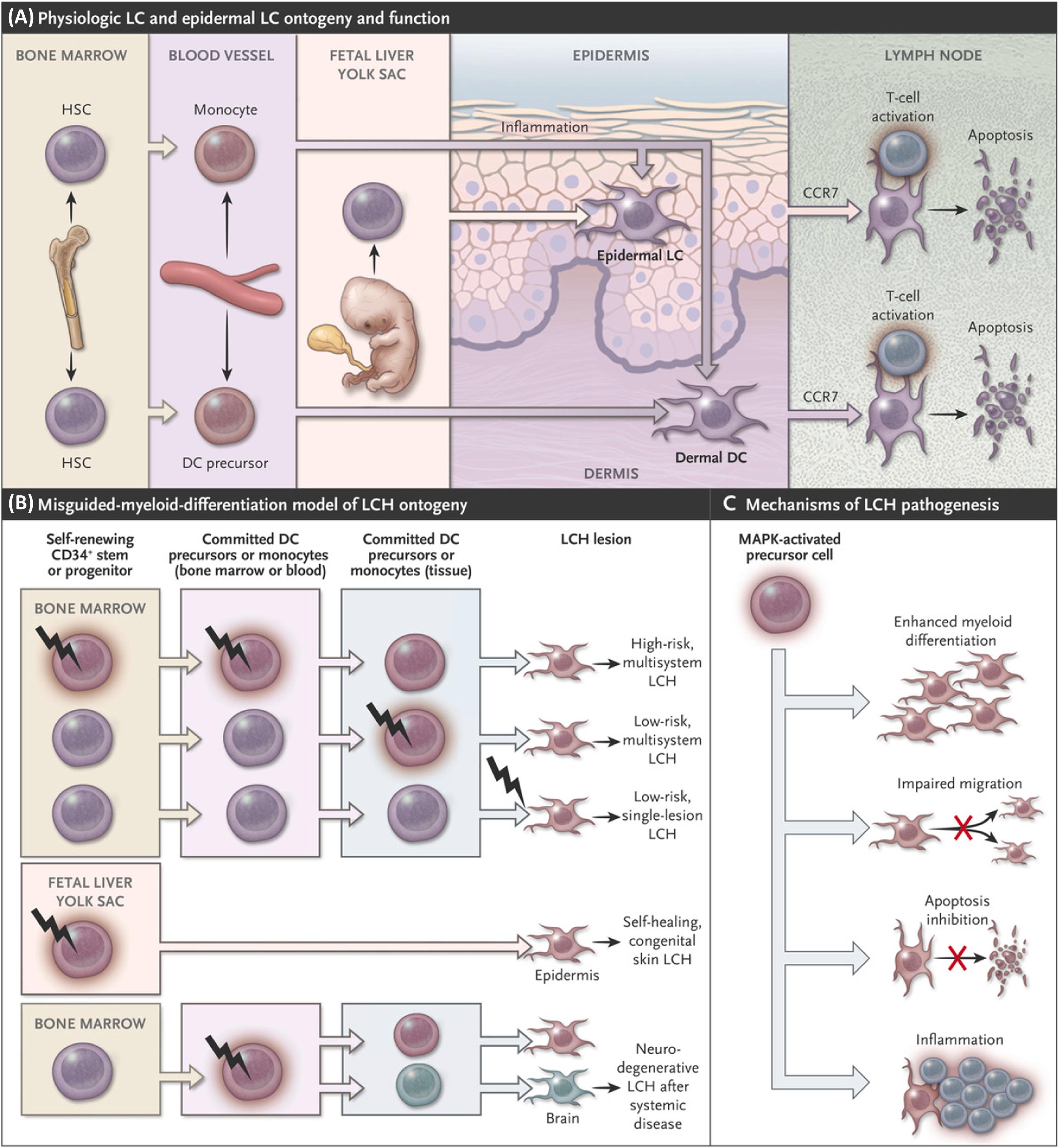 Figure 15.1, Models of LCH ontogeny and pathogenesis. Panel (A) shows physiologic LC and dermal DC ontogeny and function. Under normal conditions, LC precursors arise from yolk-sac progenitors or fetal liver monocytes that seed the epidermis and are maintained locally by radioresistant epidermal LC precursors in the steady state. Circulating DC-restricted precursors are constantly recruited to the skin to replenish dermal DCs. During injury or inflammation, bone marrow–derived monocytes can differentiate into epidermal CD207+ LC-like cells or dermal DC-like cells that replenish the damaged LC and dermal DC pool. CCR7 is required for activated epidermal LCs and dermal DCs to migrate through the lymphatics to the lymph node, where they recruit and activate T cells and are ultimately cleared through various mechanisms, including apoptosis. Panel (B) shows the misguided-myeloid-differentiation model of LCH ontogeny. According to this model, the stage of differentiation in which the myeloid cell acquires activating MAPK mutations determines the extent of LCH. High-risk, multisystem LCH arises from self-renewing stem or progenitor cells from bone marrow; low-risk, multisystem LCH arises from MAPK activation of committed DC precursors or monocytes; and a low-risk, single lesion arises from a regional DC precursor. Clinical data support a fetal-liver origin for self-healing, congenital skin LCH, and a hematopoietic origin for clonal cells that infiltrate the brain after systemic disease; a mouse model also suggests that it is possible for cells derived from the fetal yolk sac to drive neurodegeneration. Panel (C) shows mechanisms of LCH pathogenesis. MAPK activation in precursor cells contributes to the formation of LCH lesions through the following mechanisms: differentiation toward the LC phenotype, impaired migration through abrogation of CCR7 expression, and resistance to apoptosis, resulting in the accumulation of pathologic DCs and the development of an immune infiltrate that contributes to local and systemic inflammation.Abbreviations: DC , Dendritic-cell; LC , Langerhans-cell; LCH , Langerhans cell histiocytosis.