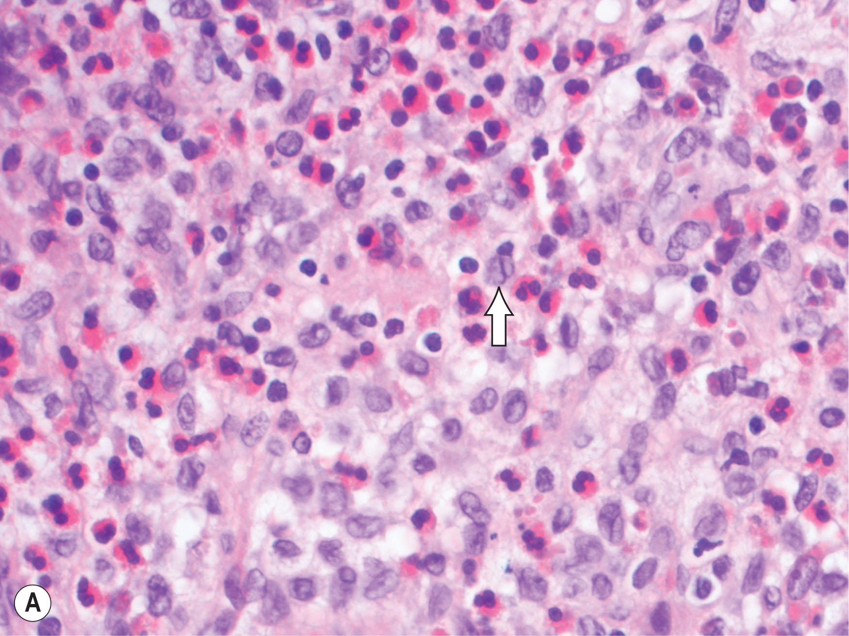 Fig. 25.1, (A) Typical presentation of adnexal Langerhans cell histiocytosis (LCH) with left proptosis and downward globe displacement. (B) Bilateral proptosis associated with LCH multisystem multifocal disease.