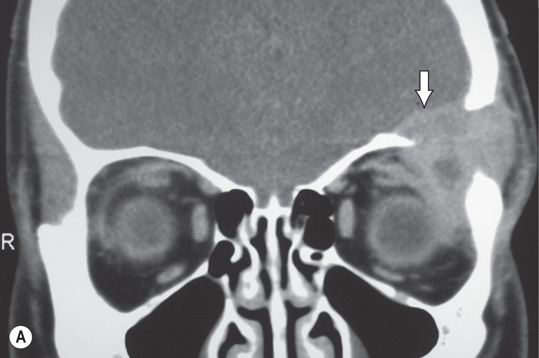 Fig. 25.2, A coronal CT scan of a child with unifocal Langerhans cell histiocytosis centered on the right lacrimal gland fossa, with marked bone erosion extending into the temporal fossa.