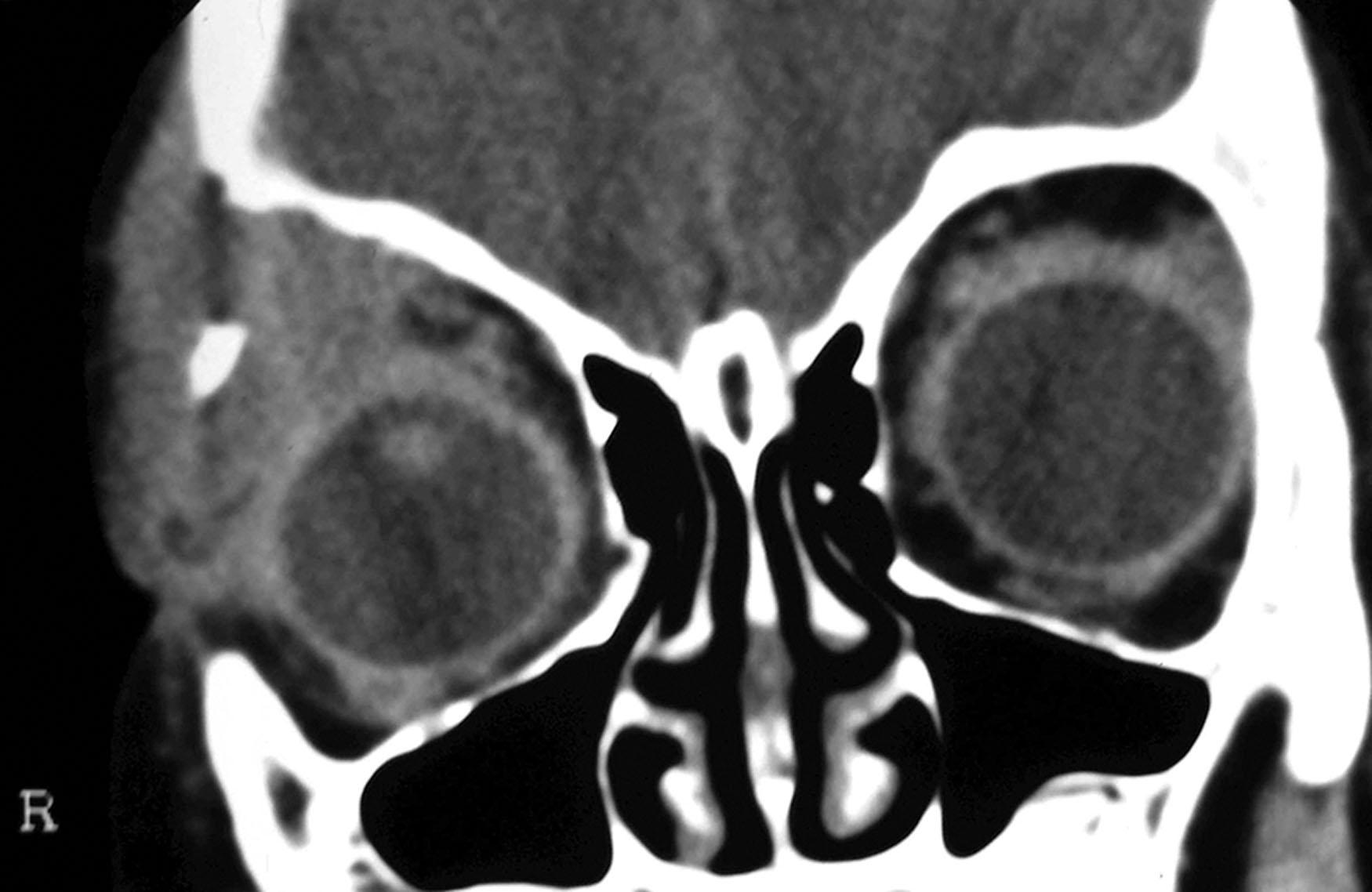 Fig. 25.4, (A) An axial CT scan of an adolescent with unifocal Langerhans cell histiocytosis, shows a lesion in the posterolateral left orbit with erosion of the greater wing of the sphenoid bone and extension into the middle cranial fossa (arrow). (B) An axial T1-weighted MRI with contrast shows the lesion centered on the greater wing of the sphenoid with extension into the posterolateral orbit and middle cranial fossa.