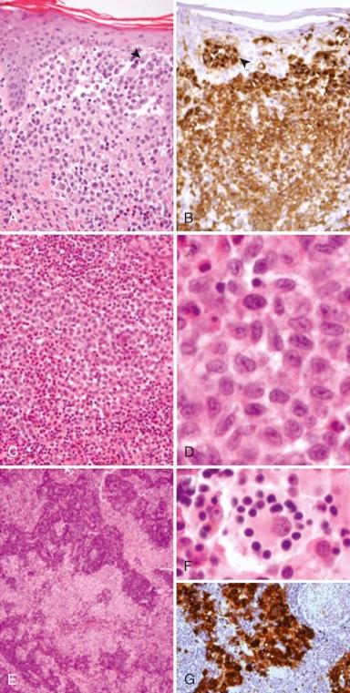 Figure 64-1, Histopathologic features of Langerhans cell histiocytosis (LCH) and sinus histiocytosis with massive lymphadenopathy (SHML). A and B, Hematoxylin and eosin ( A ) and CD1a immunostain ( B ) of LCH involving the skin. Lesional cells infiltrate the upper dermis and focally (arrowheads) involve the epidermis. C and D, Low-power (200× magnification, C ) and high-power (1000× magnification, D ) views of a hematoxylin and eosin–stained section of an LCH bone lesion. The low-power view ( C ) demonstrates tumor cells present in association with a mixed inflammatory infiltrate rich in eosinophils. The high-power view ( D ) illustrates the histologic features of the lesional Langerhans cells, including the characteristic “C-shaped” nuclei and abundant pink cytoplasm. E, F, and G, Low-power (40× magnification, E ) and high-power (1000× magnification, F ) views of a hematoxylin and eosin–stained section of SHML involving a lymph node. Pale areas in panel E represent dilated sinuses replaced by lesional histiocytes that are highlighted by an S100 immunostain in panel G . Panel F demonstrates a histiocyte that contains numerous lymphocytes, which is typical of the emperipolesis characteristic of SHML.