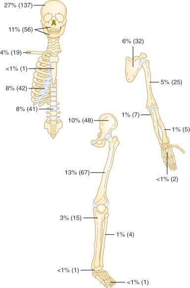 Figure 64-2, Anatomic distribution of 503 osseous lesions among 263 patients with Langerhans cell histiocytosis of bone.