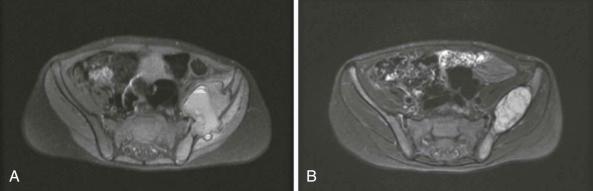 Figure 64-3, Magnetic resonance imaging scans of the pelvis of a 2-year-old boy with unifocal Langerhans cell histiocytosis of the left ilium. An expansile, destructive iliac lesion and large soft tissue mass ( A ) decreased dramatically in size within 3 months after an intralesional glucocorticoid injection ( B ).