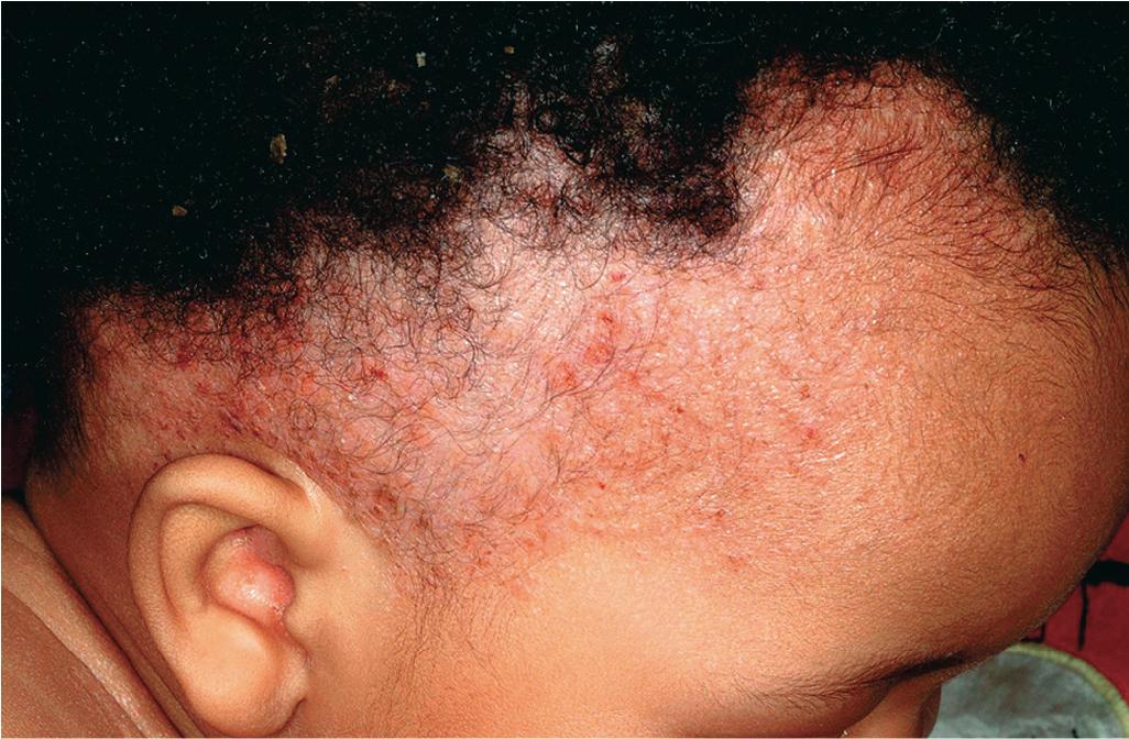 Fig. 10.1, Langerhans cell histiocytosis. Erythematous, crusted papules and plaques, with accentuation in the posterior auricular scalp.