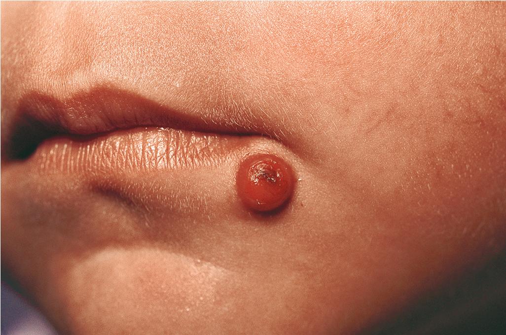 Fig. 10.12, Juvenile xanthogranuloma. This early lesion reveals a red to orange color.