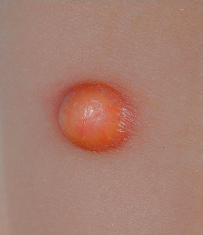 Fig. 10.13, Juvenile xanthogranuloma. An established lesion revealing the characteristic yellow to orange-brown appearance.