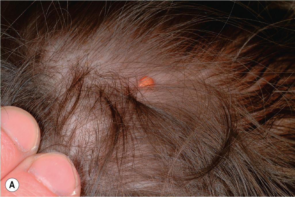 Fig. 10.14, Juvenile xanthogranuloma. Solitary yellow, dome-shaped nodular papule (A) and plaque (B) , both distributed on the scalp.