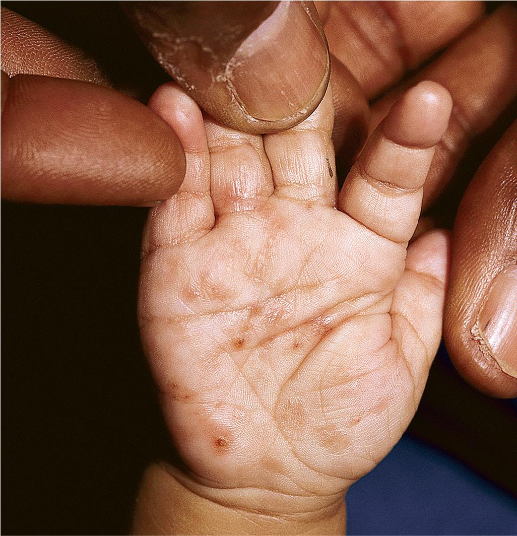 Fig. 10.4, Langerhans cell histiocytosis (LCH). Erythematous, crusted papules on the palm in this newborn with congenital multisystem LCH.