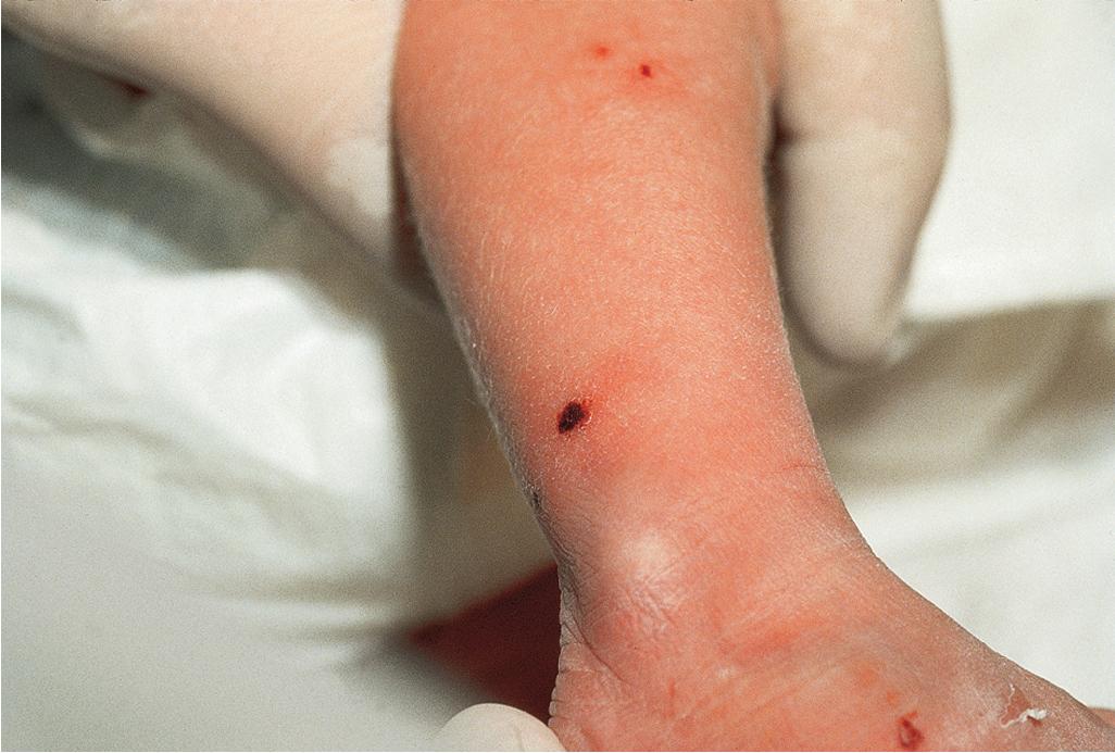 Fig. 10.5, Neonatal Langerhans cell histiocytosis (LCH). Hemorrhagic papules and papulovesicles in a neonate with congenital cutaneous LCH.