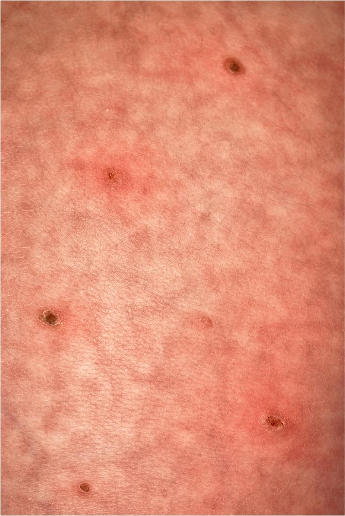 Fig. 10.6, Neonatal Langerhans cell histiocytosis (LCH). These crusted, vesicular lesions were initially felt to be suggestive of neonatal varicella in this 10-day-old female. Biopsy confirmed LCH.