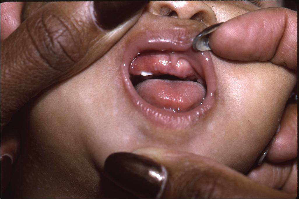 Fig. 10.8, Natal teeth in neonatal LCH. Dental eruption was noted on the upper (shown here) and lower gingivae of this newborn (same infant as shown in Fig. 10.4) with multisystem LCH.