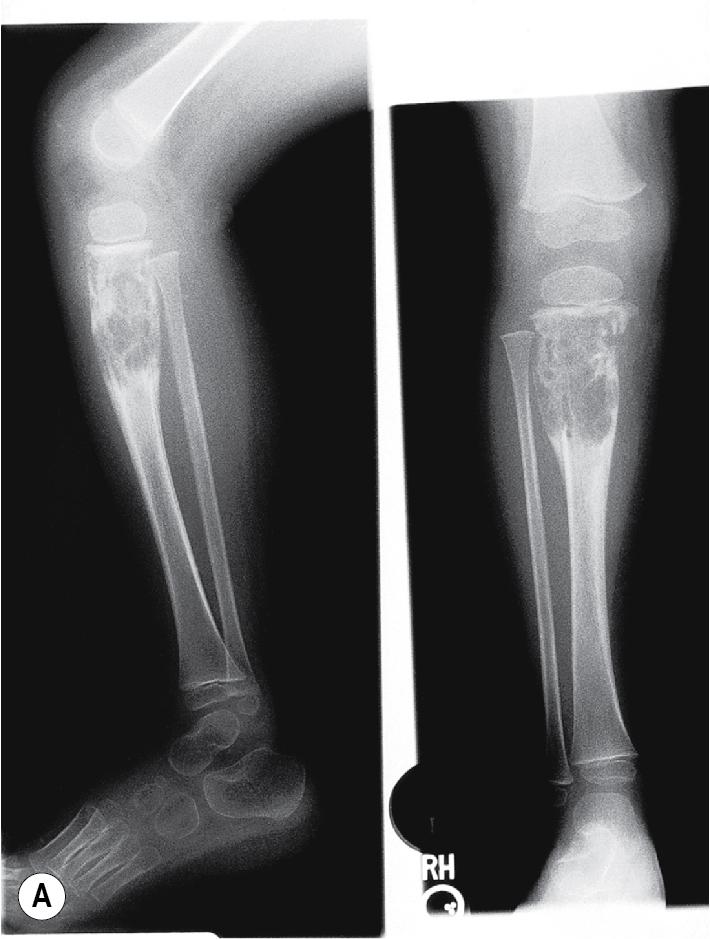 Fig. 10.9, Langerhans cell histiocytosis. Plain radiography reveals multiple lytic lesions in the tibia (A) and the skull (B) of a 4-year-old child with disseminated disease.