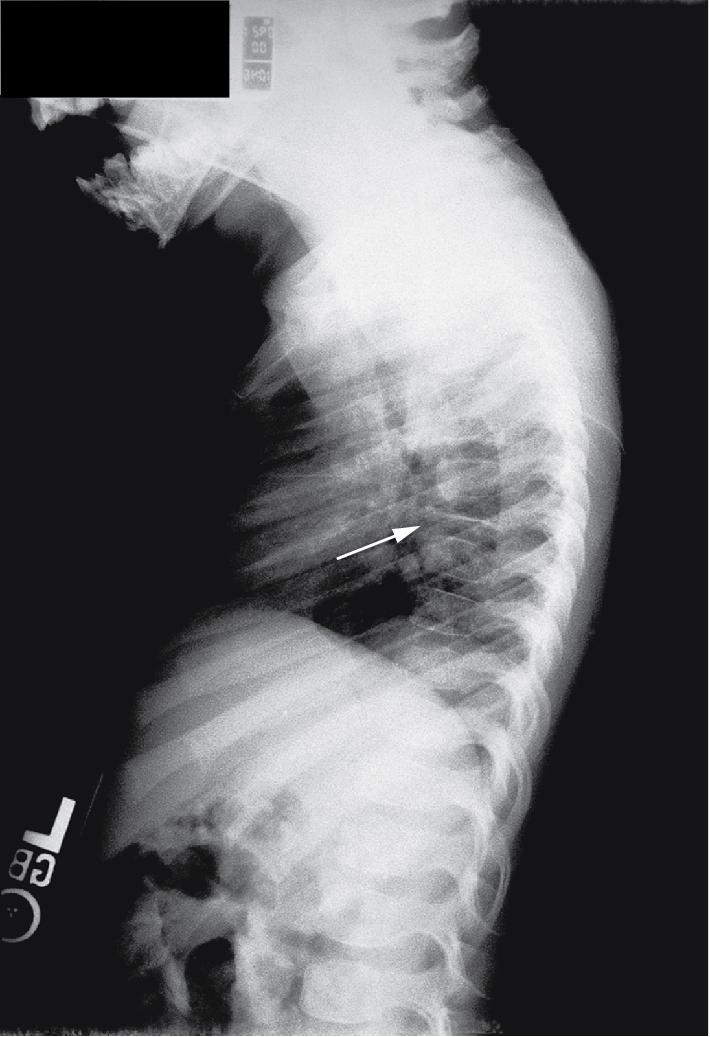 Fig. 10.10, Langerhans cell histiocytosis. Plain radiography demonstrates vertebral body compression (vertebra plana, arrow ) in the same patient as that shown in Fig. 10.9 .