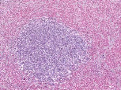 Fig. 20.11, Small, incidental pituitary adenomas found at autopsy are very common.