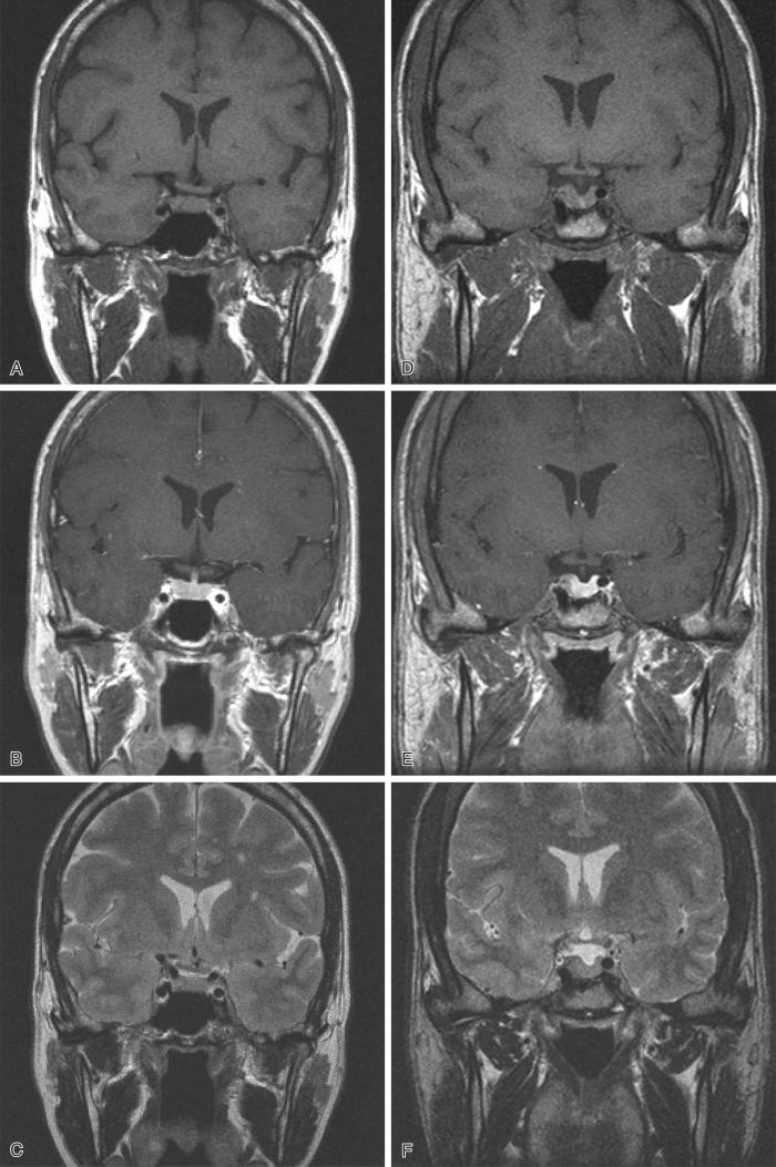 Fig. 20.12, Normal anterior gland (A–C) compared to a subtle microadenoma in the gland that eccentrically distorts the patient's right-sided gland ( left side of image; D–F) can be contrasted on matched coronal MRI sequences. T1 weighted (A, D), T1 weighted with gadolinium (B, E), T2 weighted (C, F).