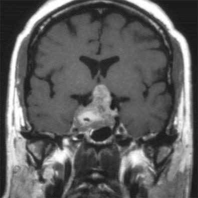 Fig. 20.13, Large pituitary adenomas (macroadenomas) are obvious mass lesions; the pathologist can only appreciate the extent to which some of these tumors involve adjacent structures on the neuroimaging studies.