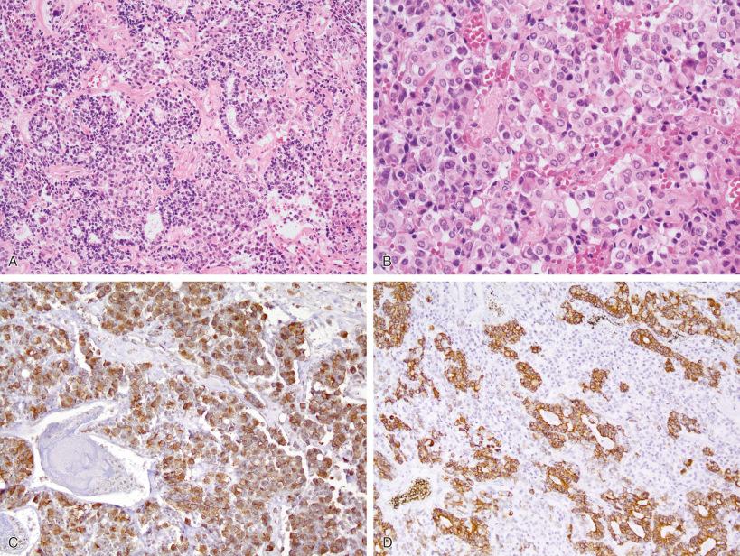 Fig. 20.14, The embryonal-like pituitary blastoma is part of the DICER1 syndrome; these tumors occur in very young children, often contain a component with an embryologic-appearing tubular component (A), as well as more solid areas (B), and are invariably ACTH-immunoreactive tumors (C). Pancytokeratin IHC (D) highlights the tubular component.