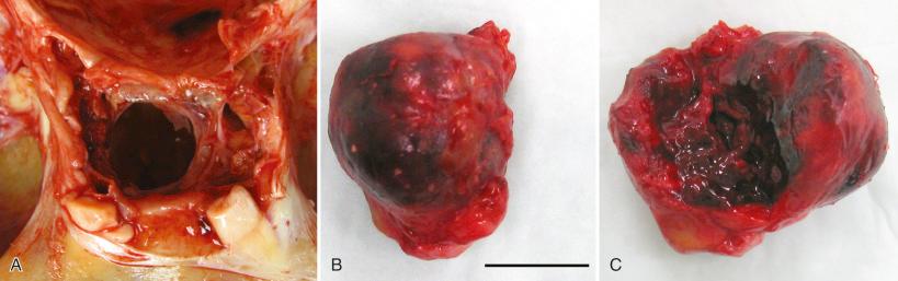 Fig. 20.2, This patient succumbed several days after presenting to hospital with right-sided periorbital pain and left-sided upper extremity weakness. Brain imaging demonstrated a right internal carotid arterial dissection and a hemorrhagic sellar region mass. At autopsy the hemorrhage had occurred in a pituitary adenoma (pituitary apoplexy). After removal of the gland, the sellar floor can be seen (A) as well as the hemorrhagic adenoma that was removed from the sella (B, C).