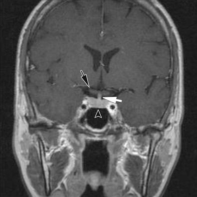 Fig. 20.3, The close proximity of normal sellar region structures is evident at autopsy, but best appreciated on neuroimaging; note the optic chiasm (dark arrow), infundibular stalk (white arrow), and pituitary gland (arrowhead). T1-weighted coronal MRI with gadolinium.