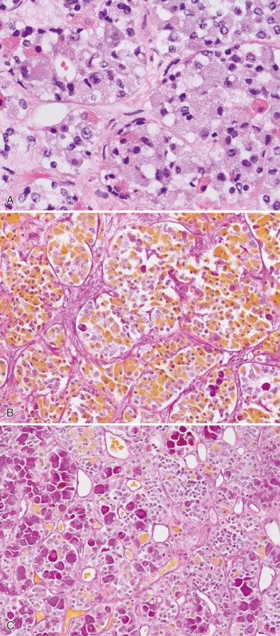 Fig. 20.5, Histochemical stains such as periodic acid–Schiff (PAS) combined with orange G. This stain can be very useful in showing that hormone cell types in the anterior gland are not equally distributed throughout the anterior lobe. While H & E stains show a cellular assortment in each acinus in normal gland (A), there are differences in distribution of orange G-positive acidophils (largely growth hormone cells) which are clustered in the lateral portions (lateral wings) of the gland (B) and the median areas (mucoid wedge) which contain large numbers of PAS-positive basophils, mostly corticotroph, and to a lesser extent, thyrotroph cells (C).