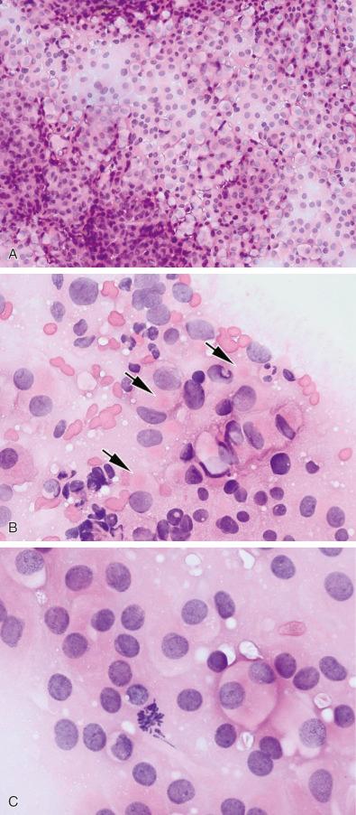 Fig. 20.8, Touch preparation shows numerous exfoliated cells and very abundant amphophilic cytoplasm of a gonadotroph adenoma (A), the faint intracytoplasmic eosinophilic balls of a sparsely granulated growth hormone adenoma (B, arrows ), and a rare mitotic figure (C).