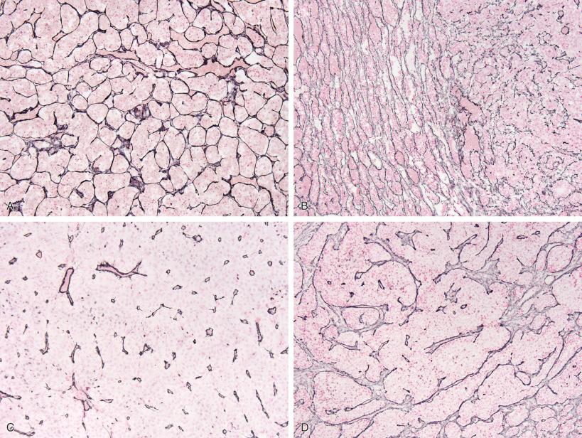 Fig. 20.9, Reticulin histochemical staining as part of the workup for pituitary adenoma surgical specimens allows recognition of the difference between preserved acinar pattern in normal adult anterior pituitary gland (A), microadenomas (B, with adenoma at right and compressed normal gland at left), and macroadenomas (C, where reticulin fibers are almost entirely lost except around vessels). An unusual reticulin pattern can be seen in some macroadenomas, usually gonadotroph adenomas, in which a macronodular appearance is evident; this should not be mistaken for hyperplasia (D).