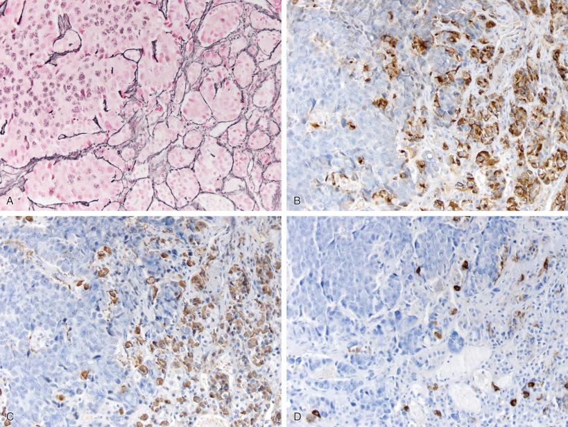 Fig. 20.10, Reticulin staining is useful even if the adenoma is easily recognizable on H & E, since it may reveal normal anterior pituitary gland at the perimeter of resected adenoma fragments (A). Immunohistochemical (IHC) reactivity for several hormone types in these normal areas should not be misinterpreted as positivity in the adenoma itself (i.e., evidence for a plurihormonal adenoma), since often a few normal entrapped cells extend into the adenoma itself (see Fig. 20.3B–D : IHC for prolactin [B], growth hormone [C], and follicle stimulated hormone [D]).