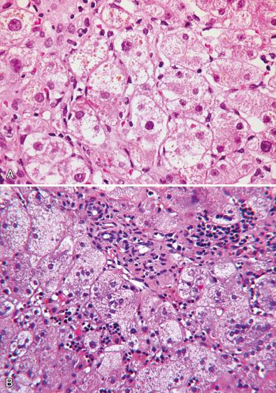 Figure 7.1, Lobular cholestasis. A, Tyrosinemia. Swollen hepatocytes contain granular cytoplasmic bile pigment in secondary lysosomes (also see eSlide 7.1 ). B, PFIC2 (bile salt export pump defect). Swollen multinucleate hepatocytes contain granular bile pigment in secondary lysosomes (also see eSlide 29B.2 , eSlide 29B.3 ).